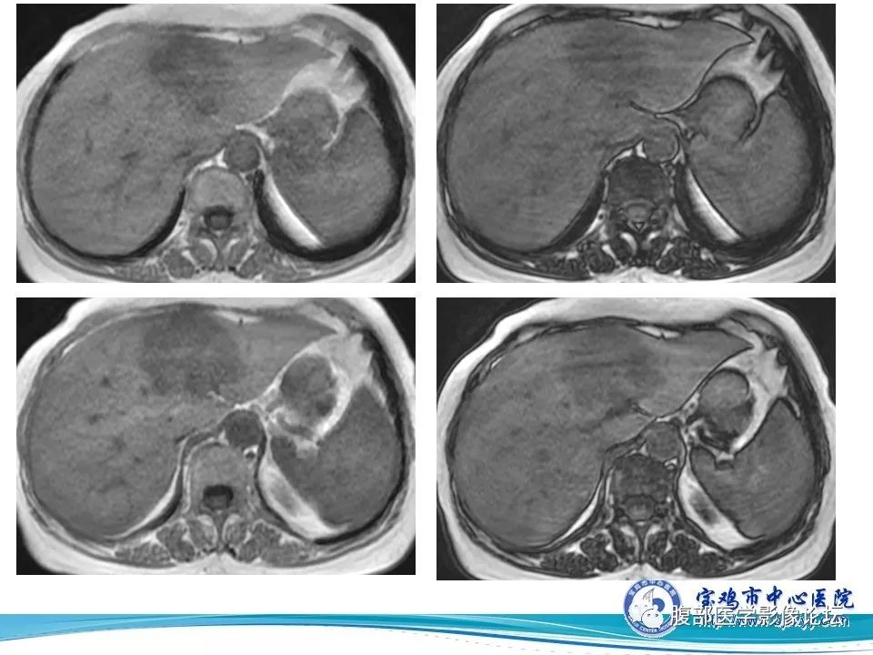【病例】肝内胆管细胞癌1例CT及MR影像表现