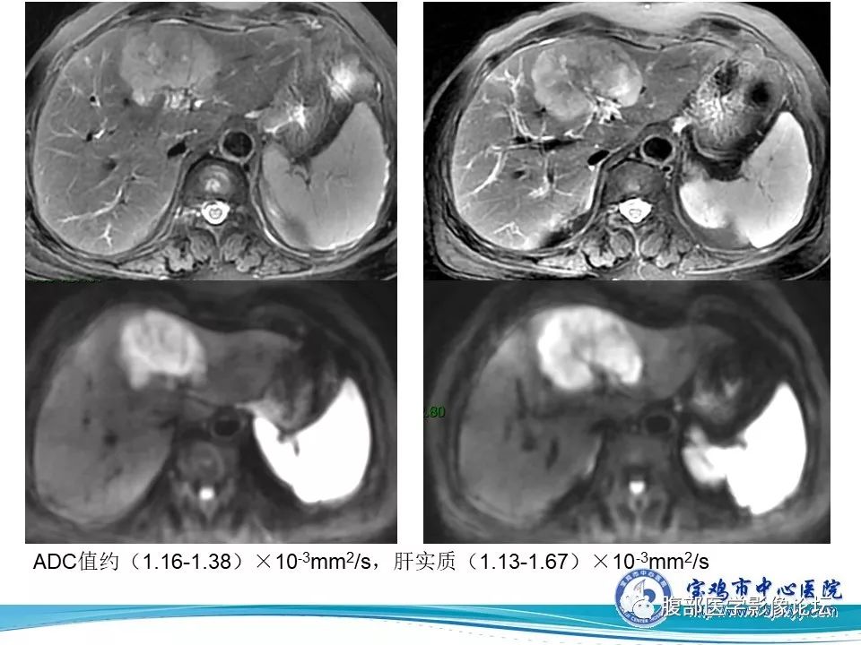 【病例】肝内胆管细胞癌1例CT及MR影像表现