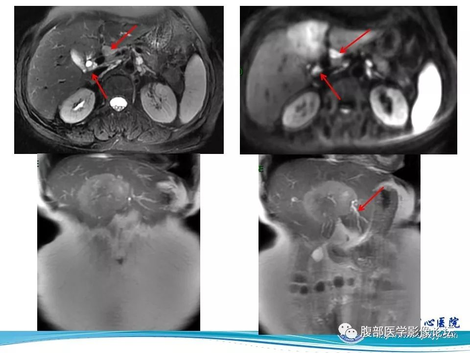 【病例】肝内胆管细胞癌1例CT及MR影像表现