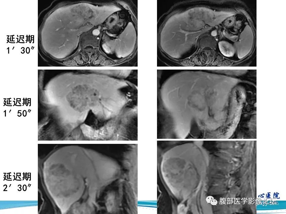 【病例】肝内胆管细胞癌1例CT及MR影像表现