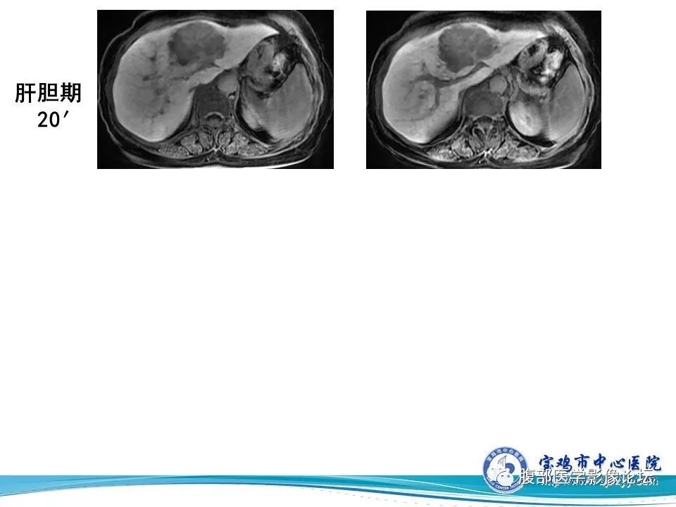 【病例】肝内胆管细胞癌1例CT及MR影像表现