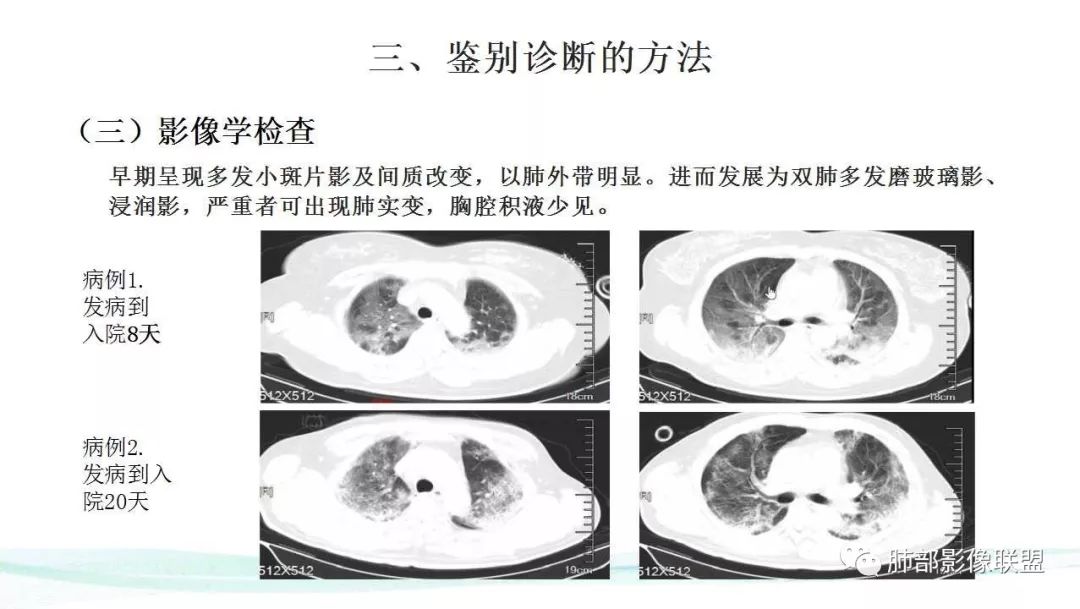 【PPT】新型冠状病毒肺炎的鉴别诊断
