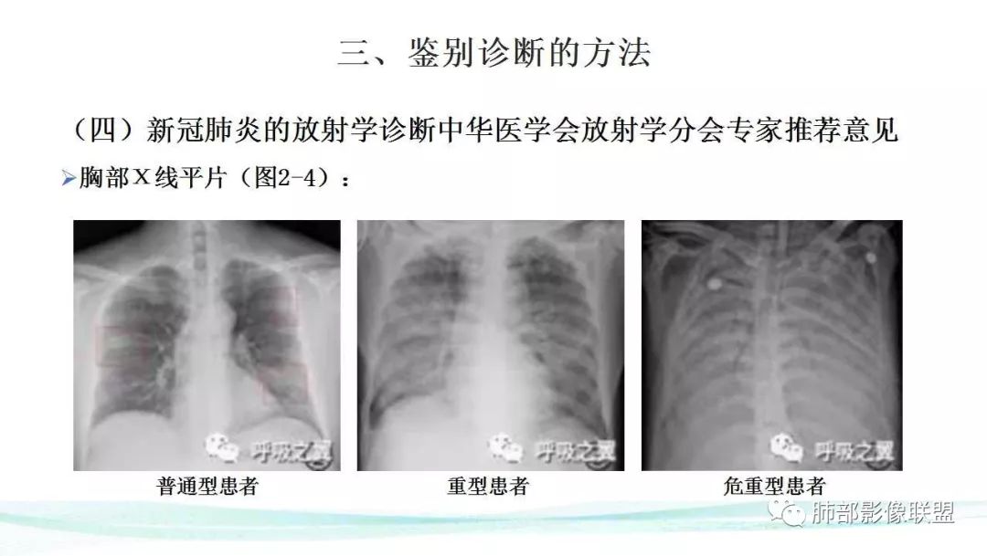 【PPT】新型冠状病毒肺炎的鉴别诊断