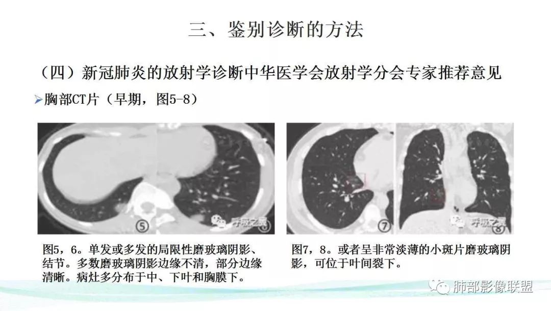 【PPT】新型冠状病毒肺炎的鉴别诊断