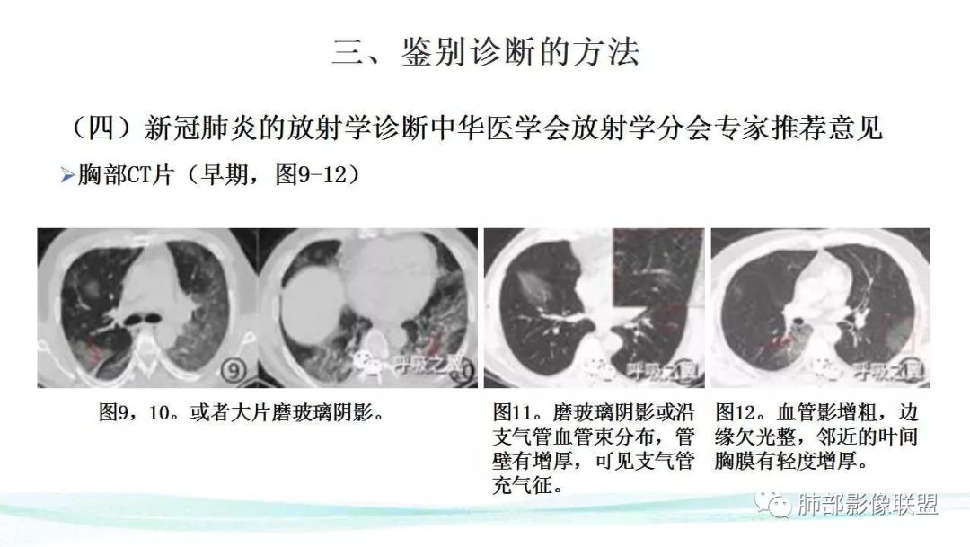 【PPT】新型冠状病毒肺炎的鉴别诊断