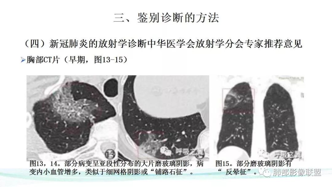 【PPT】新型冠状病毒肺炎的鉴别诊断