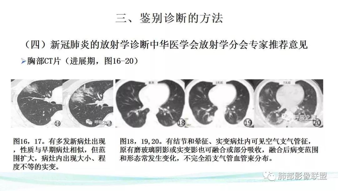 【PPT】新型冠状病毒肺炎的鉴别诊断