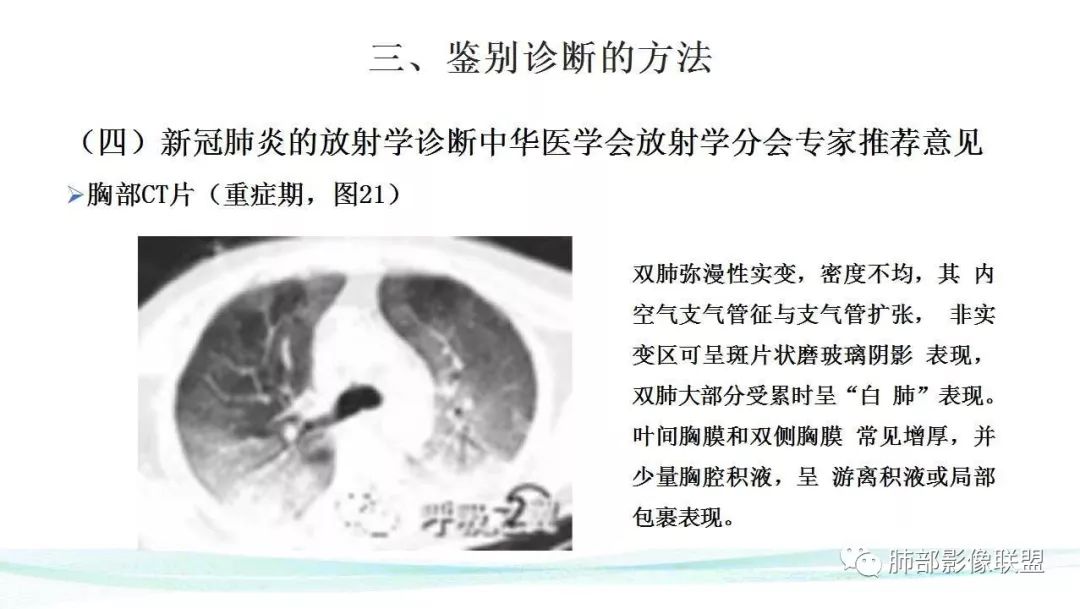 【PPT】新型冠状病毒肺炎的鉴别诊断