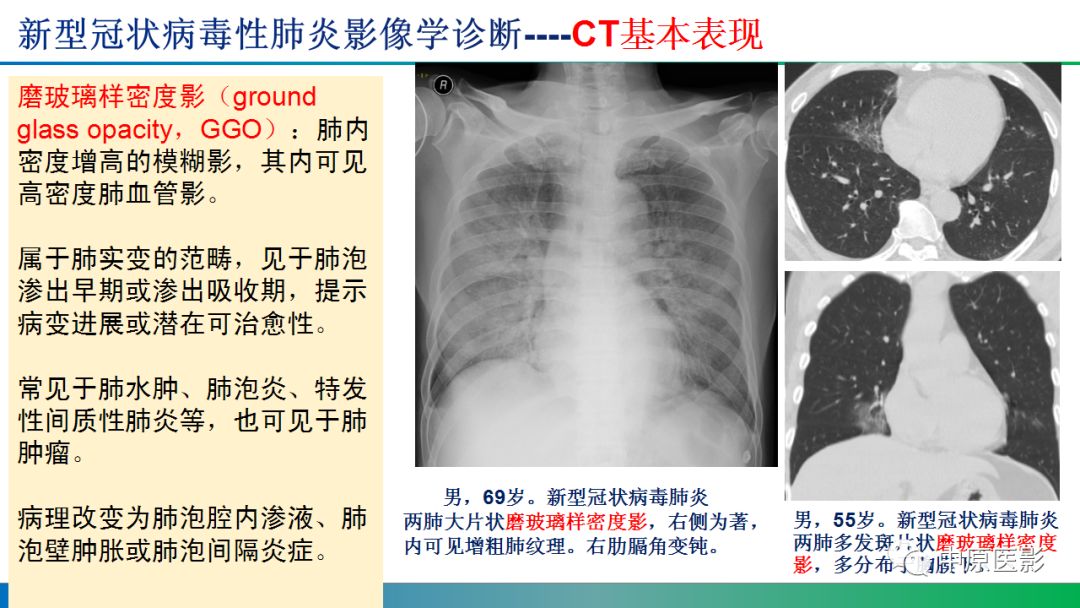 【PPT】新型冠状病毒肺炎影像学诊断浅析