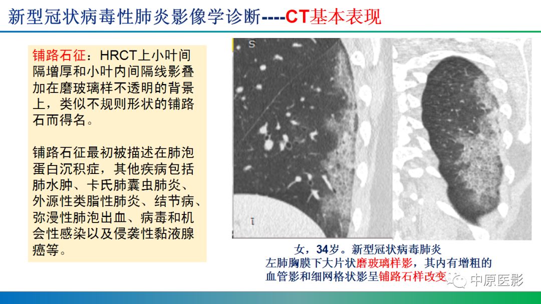 【PPT】新型冠状病毒肺炎影像学诊断浅析