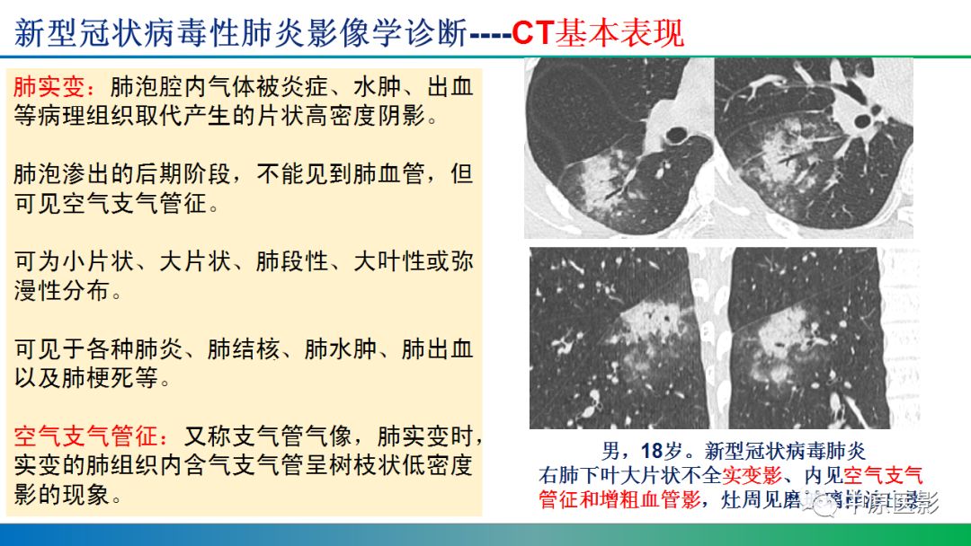 【PPT】新型冠状病毒肺炎影像学诊断浅析