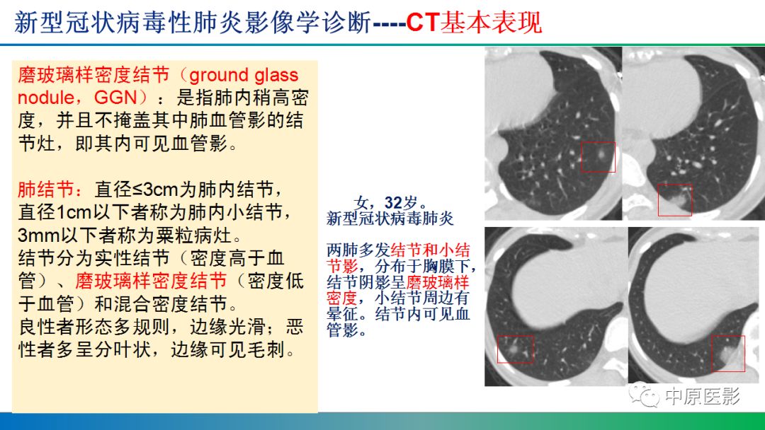 【PPT】新型冠状病毒肺炎影像学诊断浅析