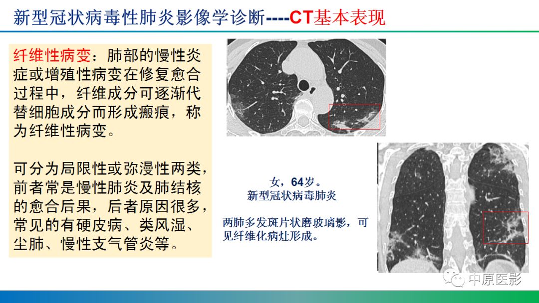 【PPT】新型冠状病毒肺炎影像学诊断浅析
