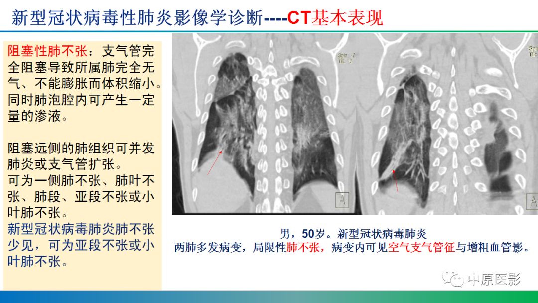 【PPT】新型冠状病毒肺炎影像学诊断浅析