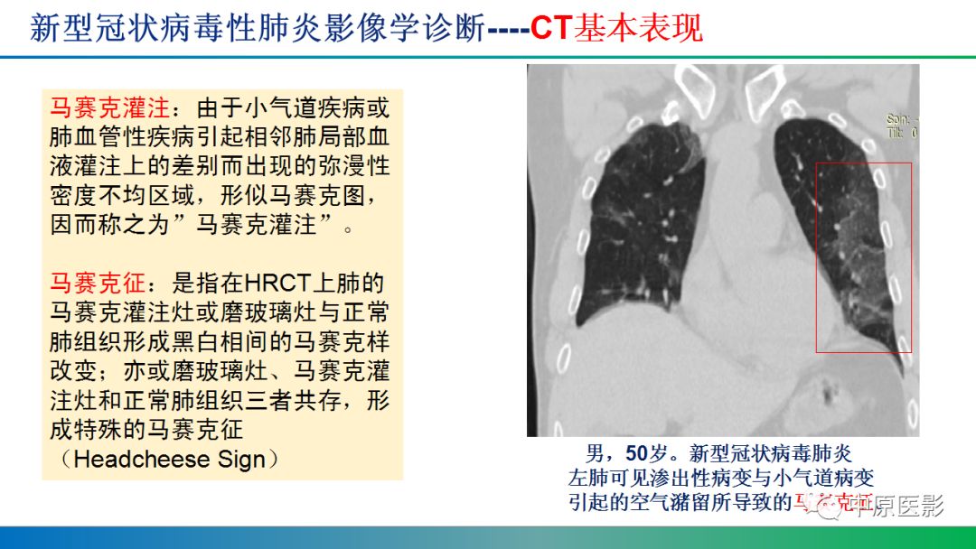 【PPT】新型冠状病毒肺炎影像学诊断浅析