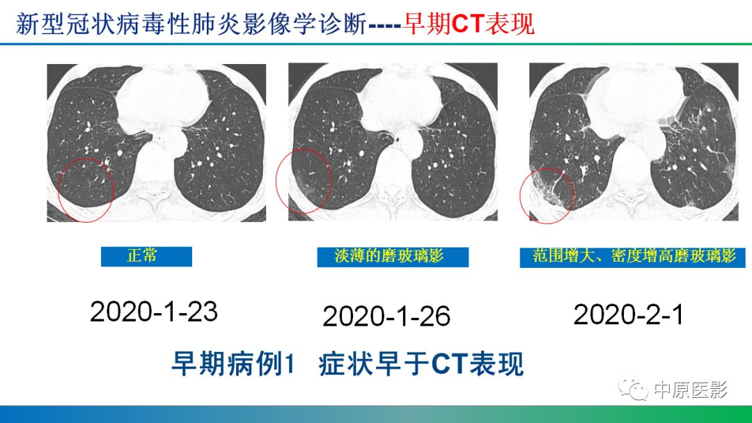 【PPT】新型冠状病毒肺炎影像学诊断浅析
