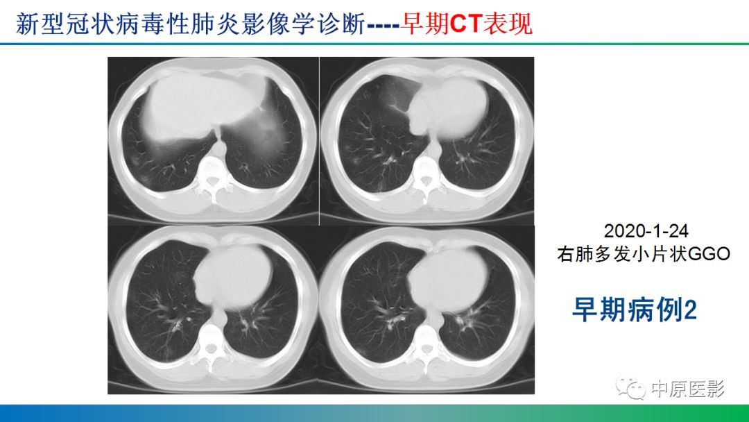 【PPT】新型冠状病毒肺炎影像学诊断浅析