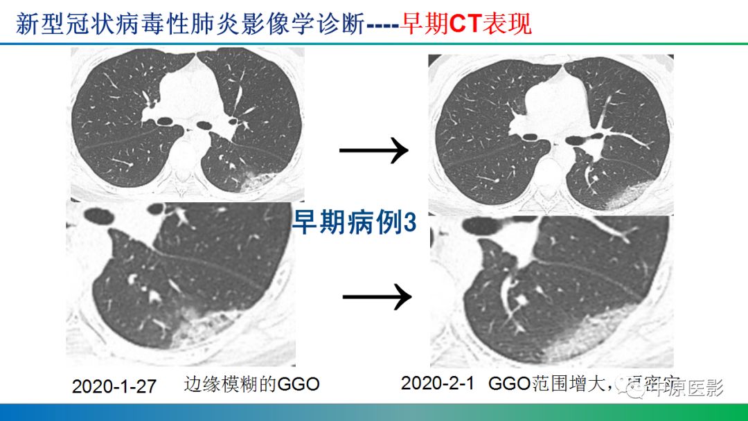 【PPT】新型冠状病毒肺炎影像学诊断浅析