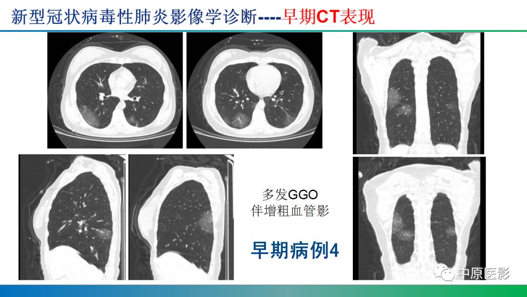 【PPT】新型冠状病毒肺炎影像学诊断浅析
