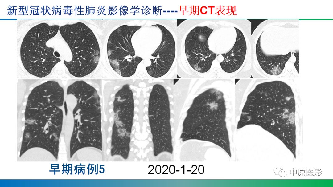 【PPT】新型冠状病毒肺炎影像学诊断浅析