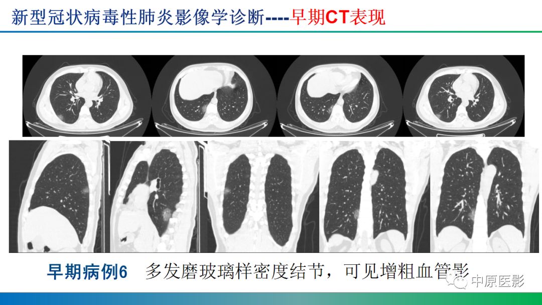 【PPT】新型冠状病毒肺炎影像学诊断浅析