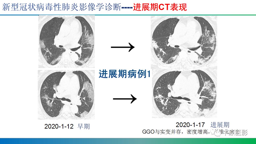 【PPT】新型冠状病毒肺炎影像学诊断浅析