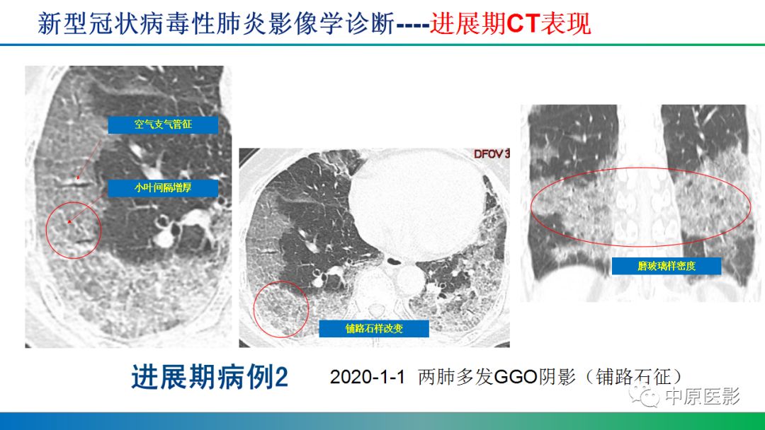 【PPT】新型冠状病毒肺炎影像学诊断浅析