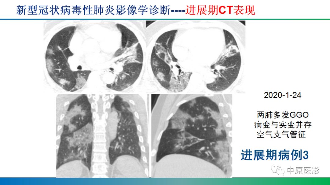 【PPT】新型冠状病毒肺炎影像学诊断浅析