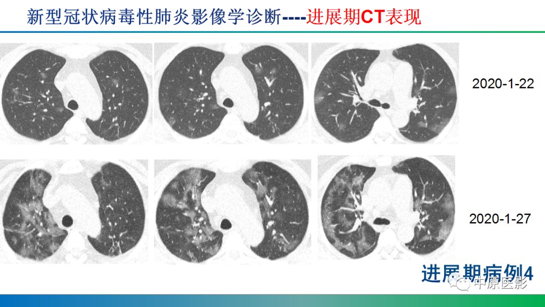 【PPT】新型冠状病毒肺炎影像学诊断浅析