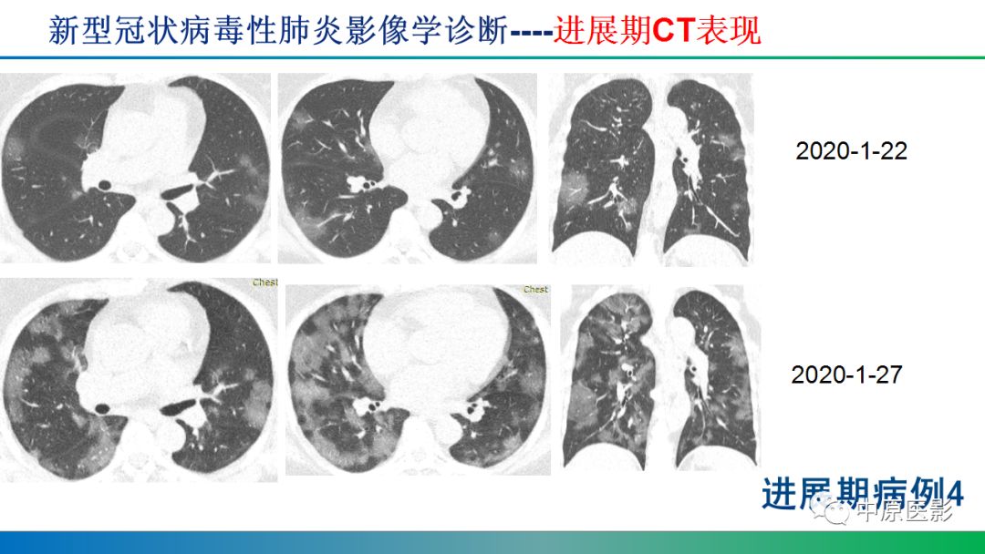 【PPT】新型冠状病毒肺炎影像学诊断浅析