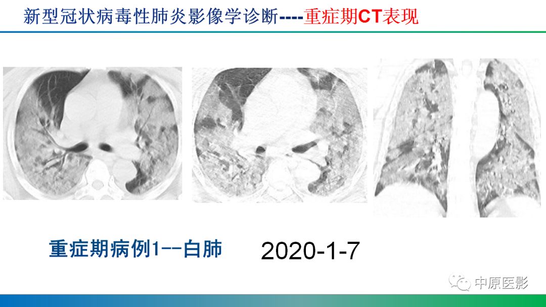 【PPT】新型冠状病毒肺炎影像学诊断浅析