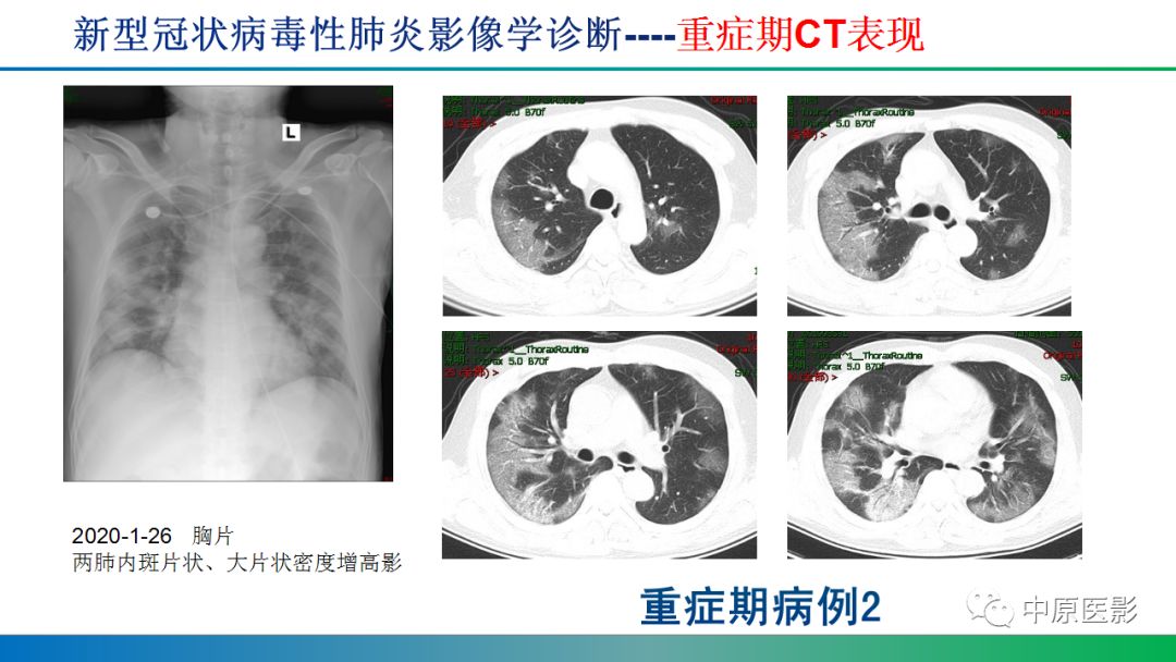 【PPT】新型冠状病毒肺炎影像学诊断浅析