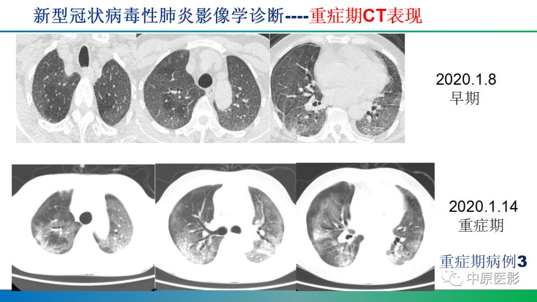 【PPT】新型冠状病毒肺炎影像学诊断浅析