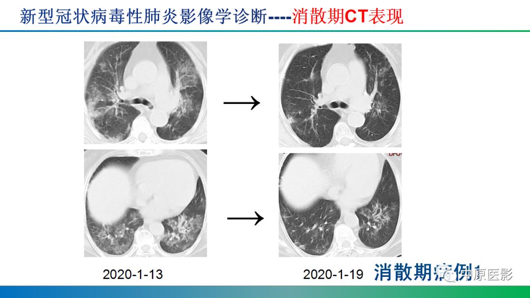 【PPT】新型冠状病毒肺炎影像学诊断浅析