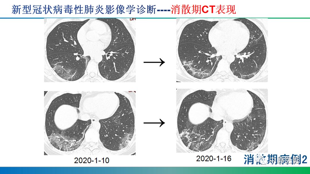 【PPT】新型冠状病毒肺炎影像学诊断浅析