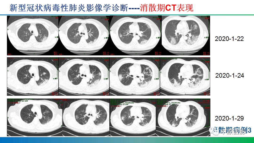 【PPT】新型冠状病毒肺炎影像学诊断浅析
