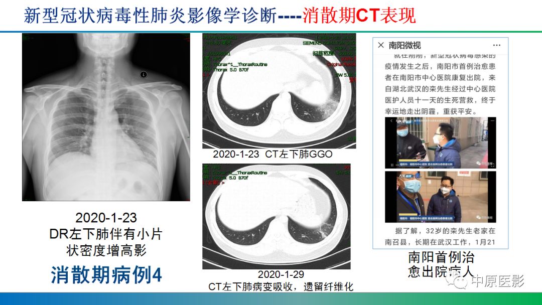 【PPT】新型冠状病毒肺炎影像学诊断浅析