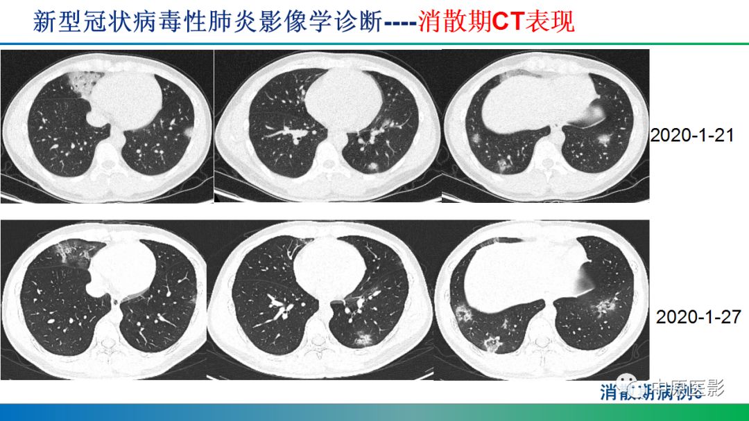 【PPT】新型冠状病毒肺炎影像学诊断浅析