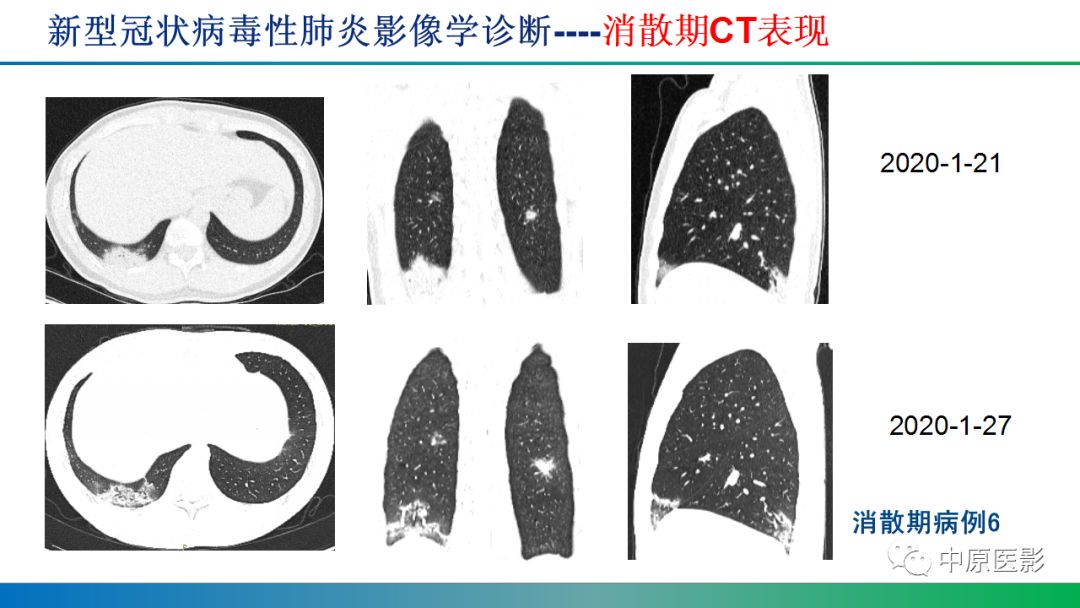 【PPT】新型冠状病毒肺炎影像学诊断浅析