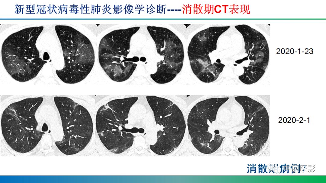 【PPT】新型冠状病毒肺炎影像学诊断浅析