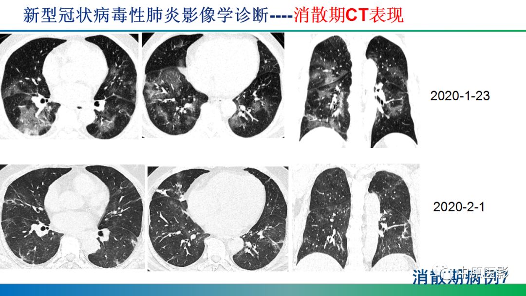 【PPT】新型冠状病毒肺炎影像学诊断浅析