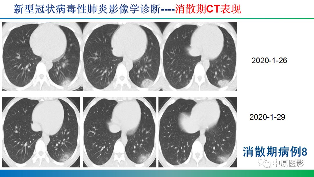 【PPT】新型冠状病毒肺炎影像学诊断浅析