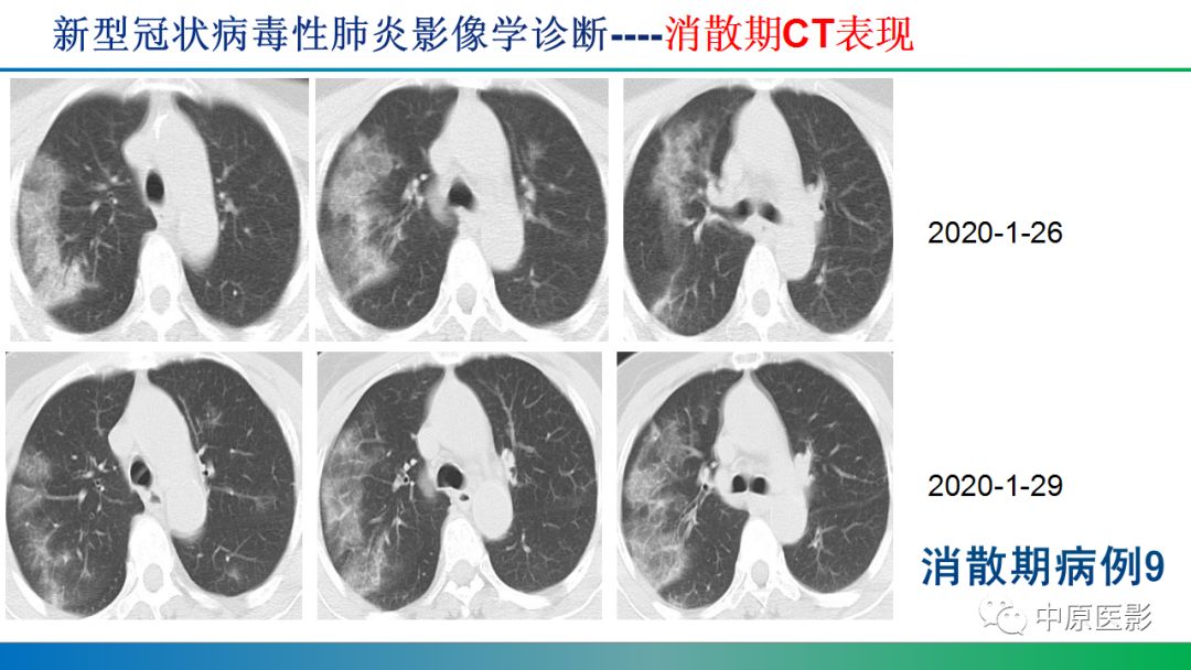 【PPT】新型冠状病毒肺炎影像学诊断浅析