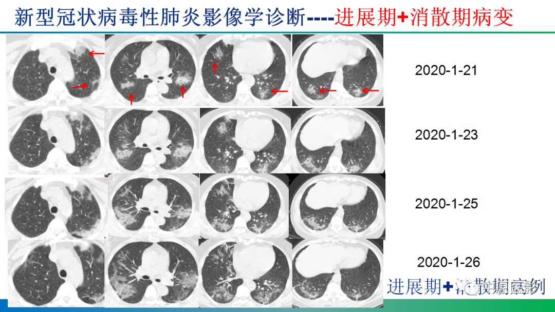 【PPT】新型冠状病毒肺炎影像学诊断浅析