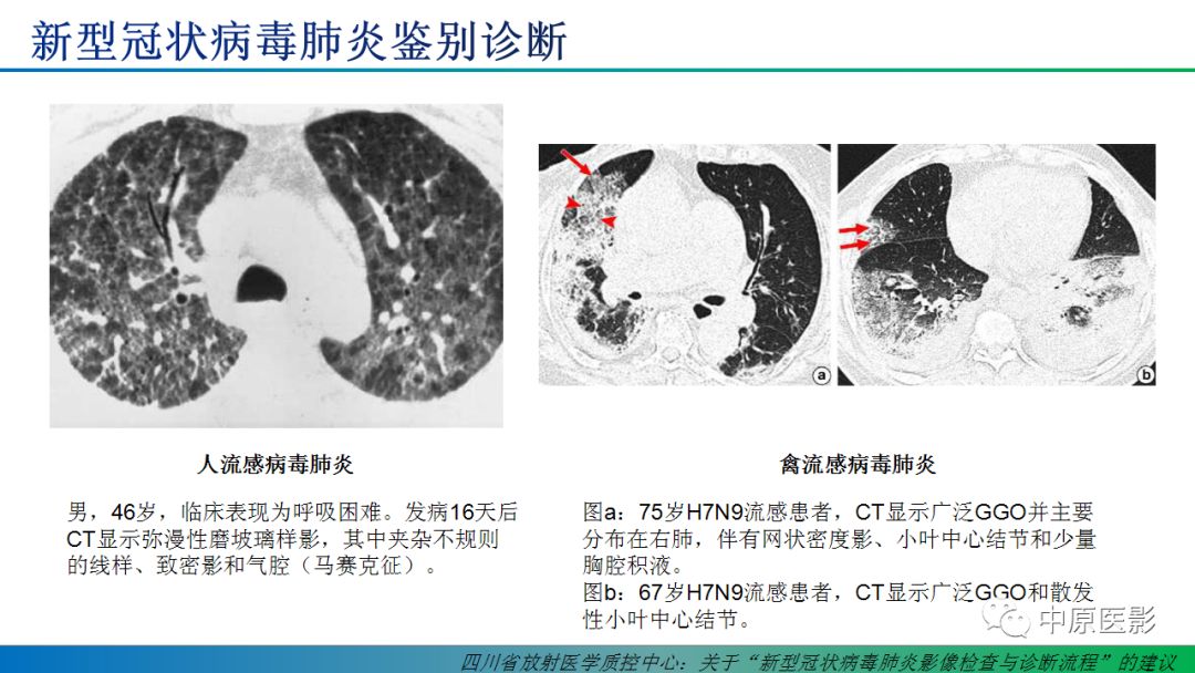 【PPT】新型冠状病毒肺炎影像学诊断浅析