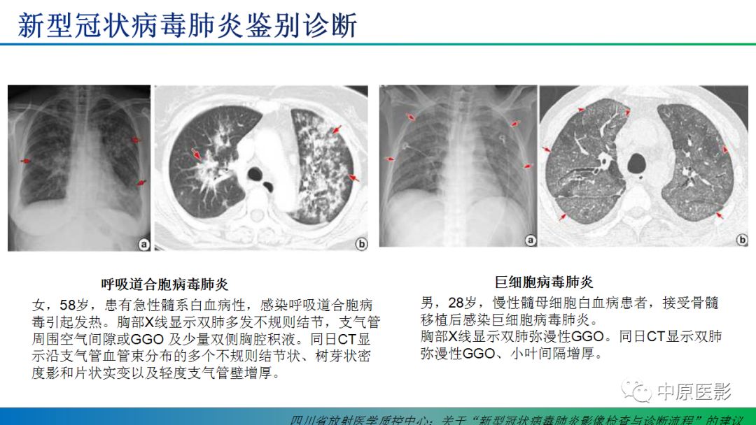 【PPT】新型冠状病毒肺炎影像学诊断浅析