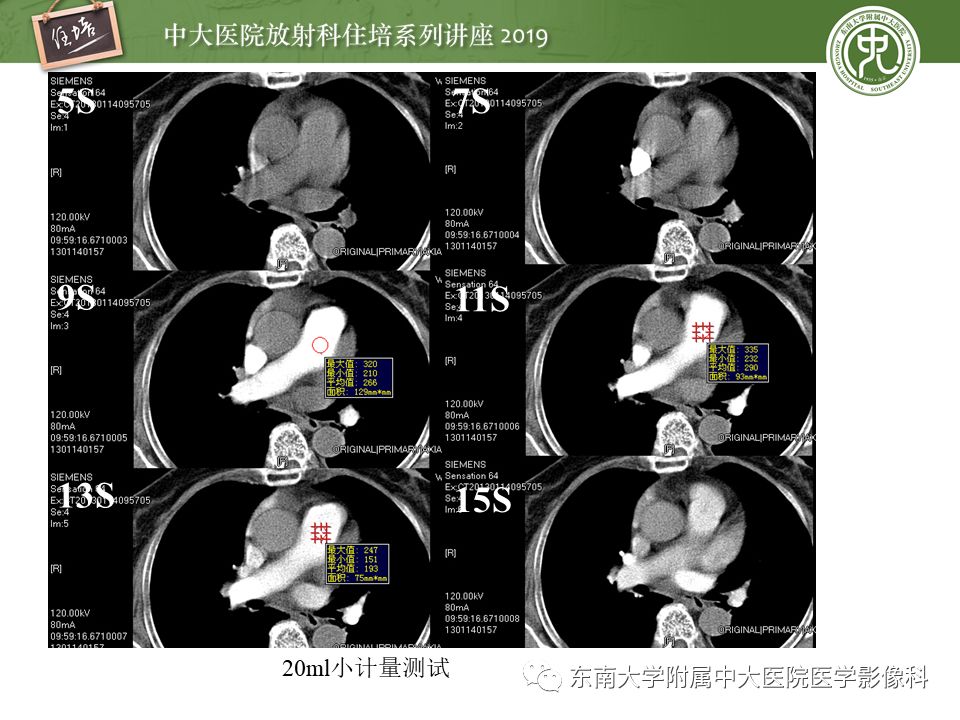 【PPT】肺动脉栓塞扫描流程、三维重建及影像评估