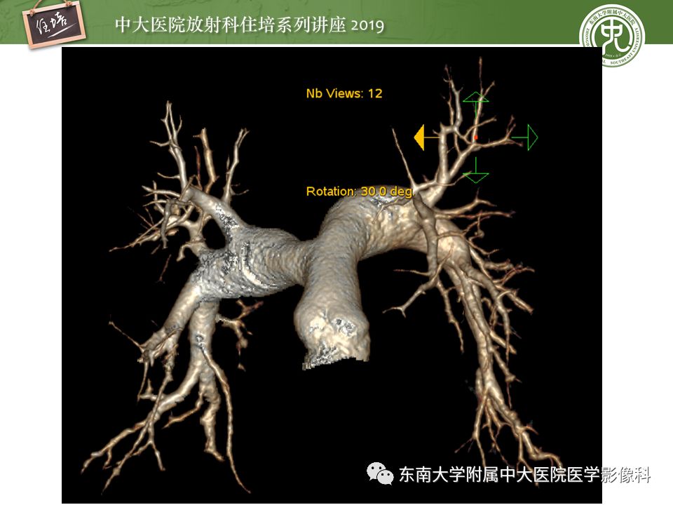 【PPT】肺动脉栓塞扫描流程、三维重建及影像评估