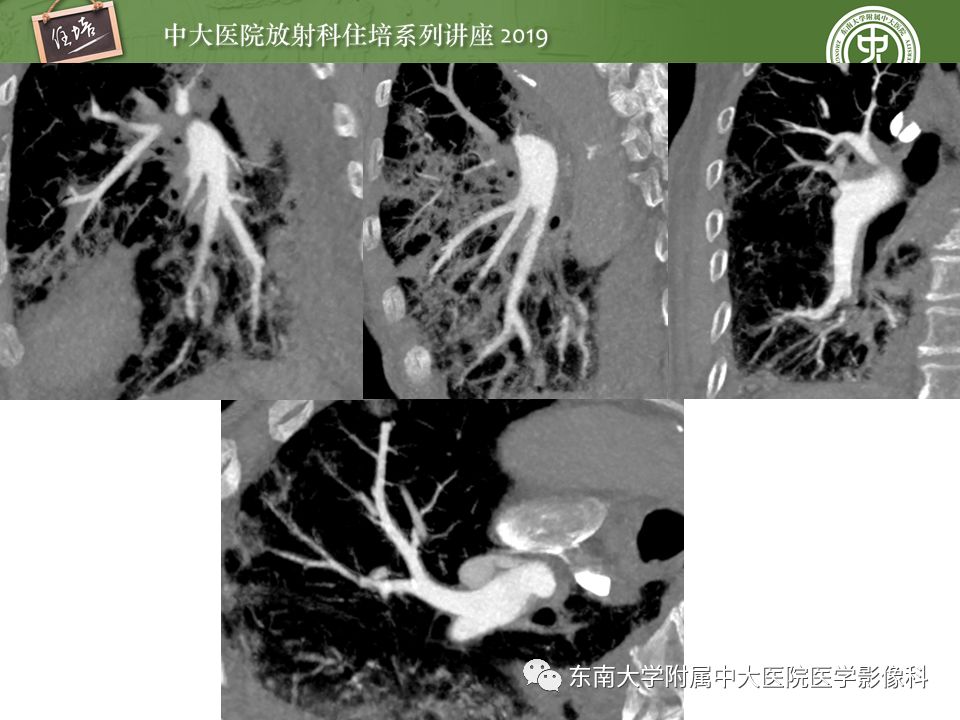 【PPT】肺动脉栓塞扫描流程、三维重建及影像评估