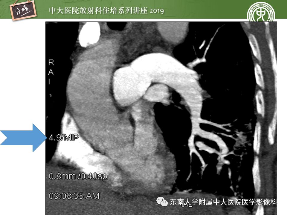 【PPT】肺动脉栓塞扫描流程、三维重建及影像评估